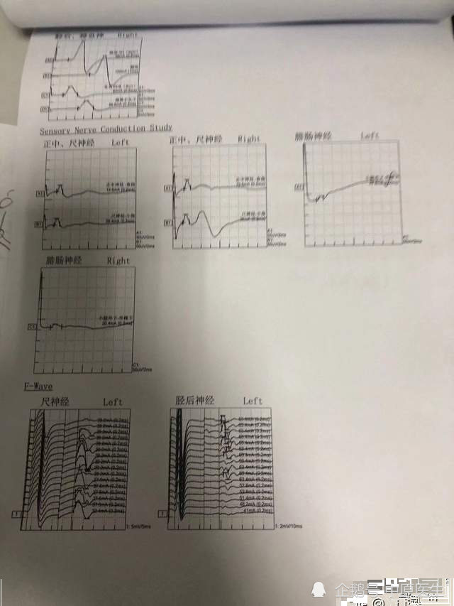 即渐冻症,同时结合患者和其家属的要求,以及病情的变化状况,行肌电图