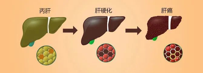 丙肝病情隐匿危害大,这3个方法让你尽早发现它