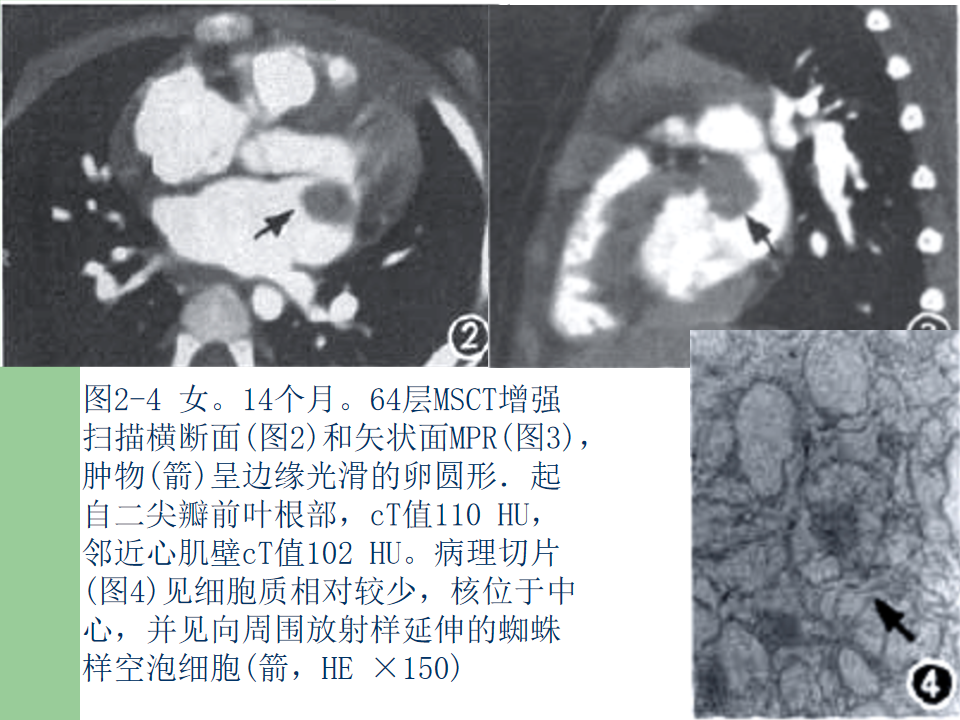 心脏肿瘤ct诊断