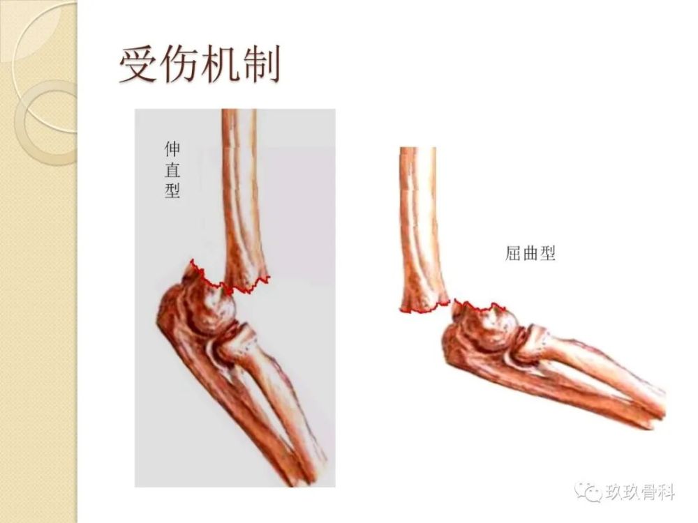 儿童常见肘关节骨折