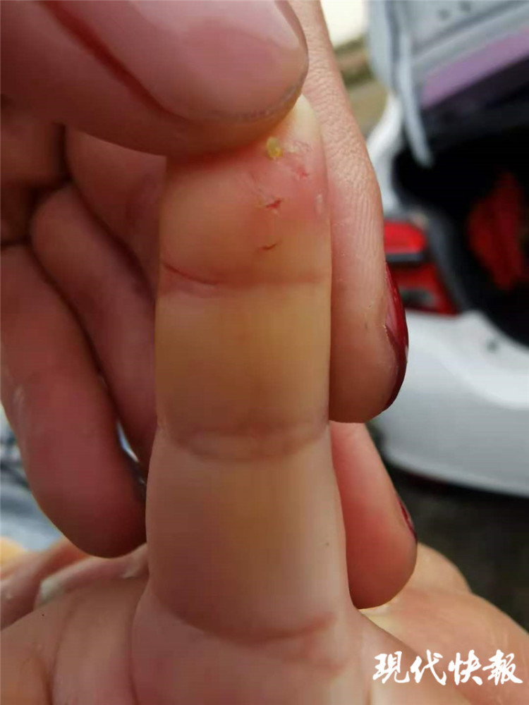 孩子被兔子咬伤的手指