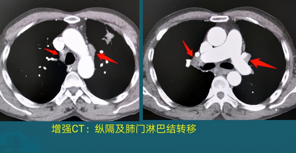 而且很遗憾,他也不是早期了,增强ct发现纵隔及双侧肺门 多发淋巴结