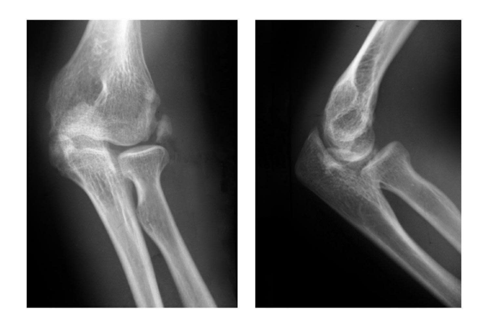 例2:肱骨内上髁Ⅲ度骨折并外上髁撕脱骨折.