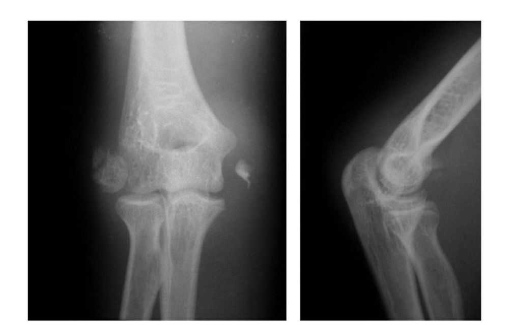7种67肘部损伤x片详细图解