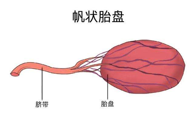 实际上,帆状胎盘是脐带异常 或者说是脐带插入异常.