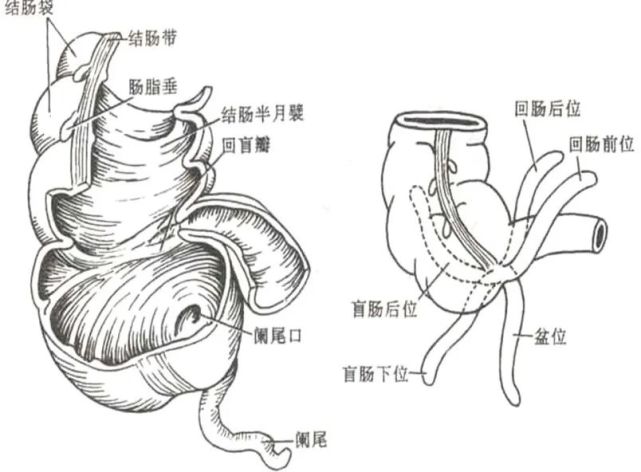 结肠袋带肠脂垂,三大特点记心上; 盲肠位居右髂窝,阑尾根部连于盲