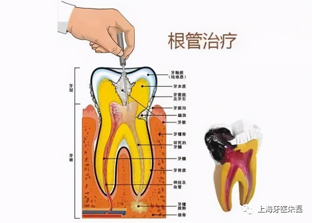 根管再治疗上海牙医朱磊