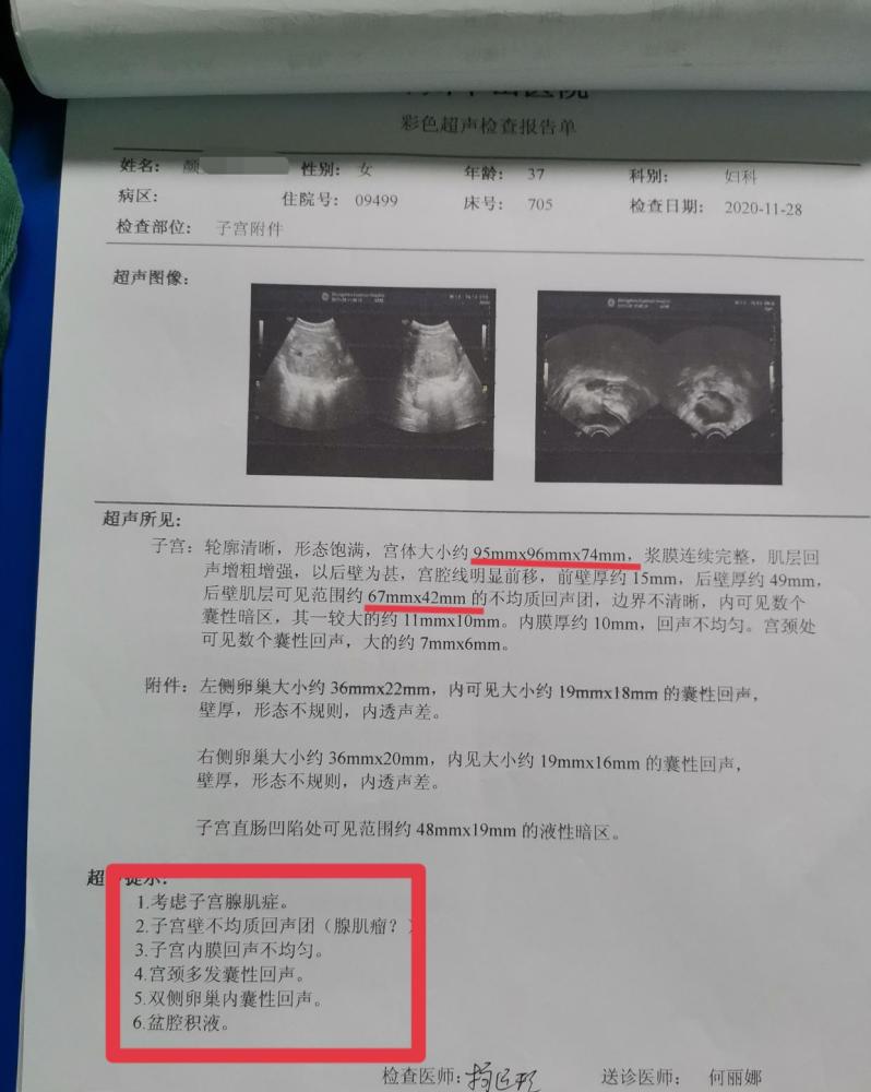 患"卵巢巧克力囊肿"行腹腔镜下卵巢囊肿剥除术,查彩超提示:子宫腺肌病