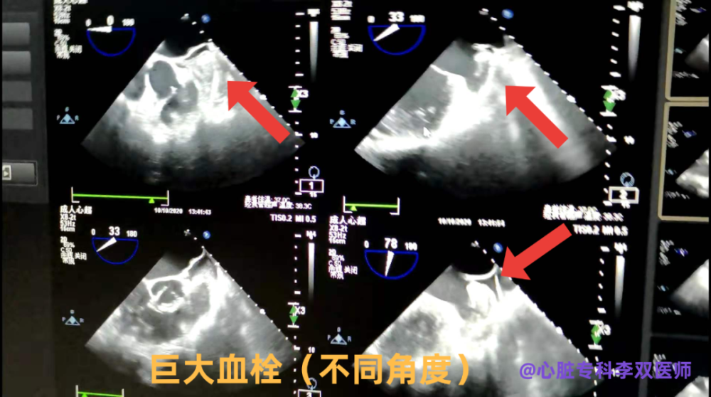 频发房颤,左心耳巨大血栓,下了 3 次病危,最终好转出院!