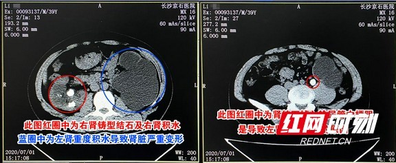 发现肾脏小结石之后的正确做法 听听医生怎么说