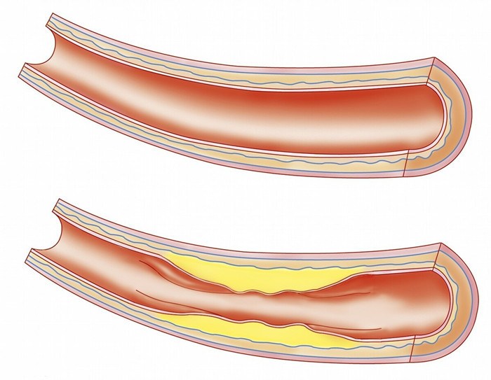 一,血管斑块是怎么形成的?