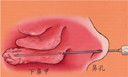 实在无效者,可以进行低温等离子射频消融来缩小下鼻甲