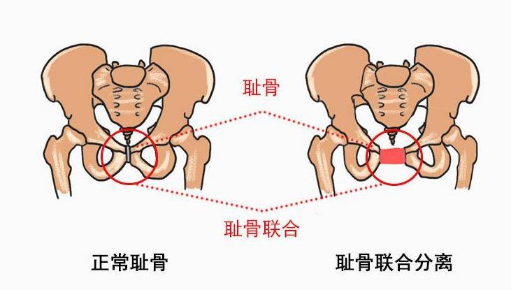 "耻骨痛"到底是哪里痛?孕期有四类孕妇容易被它"找上门"