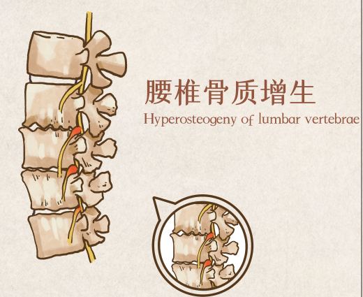 舒筋有话说:腰椎间盘突出的常见并发症