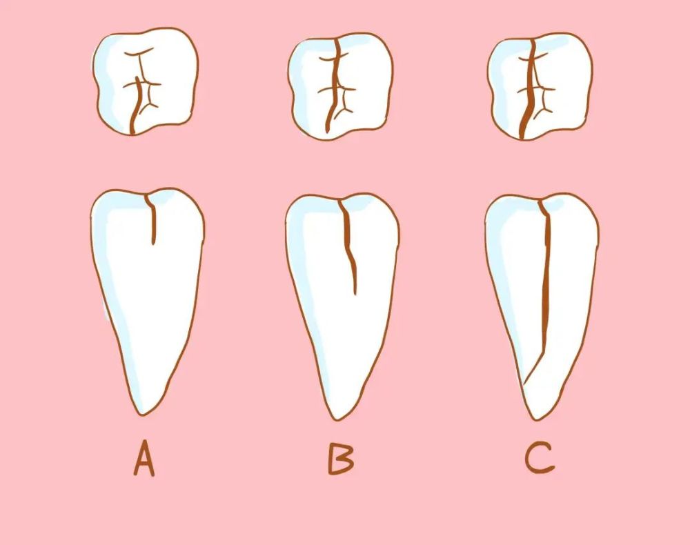 治疗方法:可将牙齿劈裂的两部分结扎牢固后,再做冠修复.