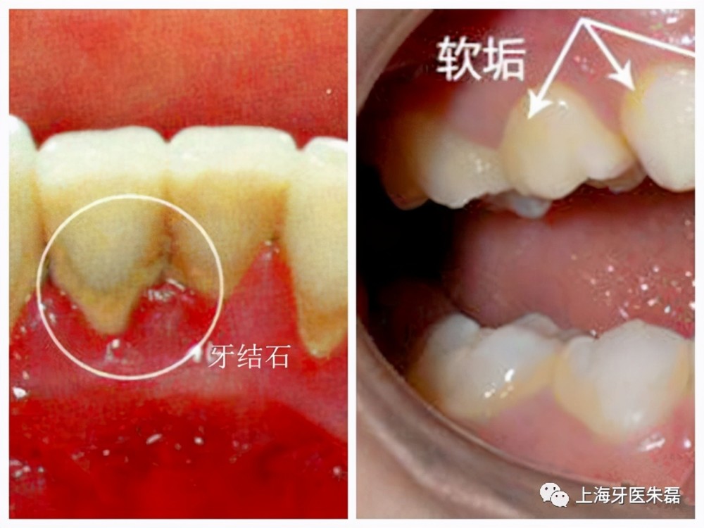 如果仍有大于5毫米的牙周袋,并且有探诊出血,或者牙龈和牙槽骨的形态