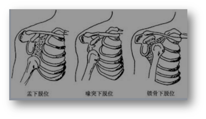 一个动作,自测是否有肩关节脱位