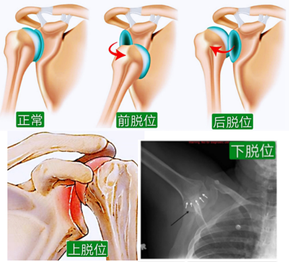 一个动作,自测是否有肩关节脱位