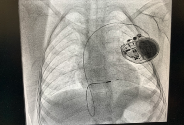 4岁女童植入长寿命心脏起搏器|永久起搏器|李小梅|北京华信医院|心脏