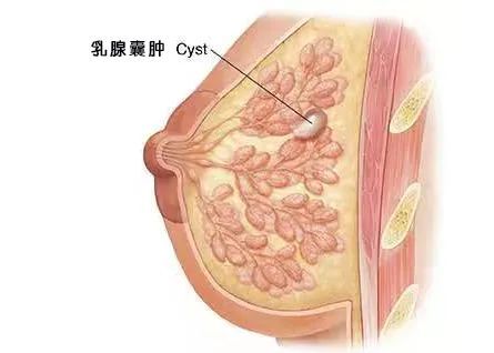 乳腺囊肿形成的原因,常常是因为 输出导管阻塞并扩张,导致小叶单位内