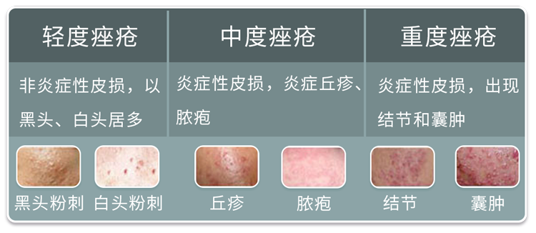 按严重程度将其分为3种《中国痤疮治疗指南》首先得知道痘痘的类型