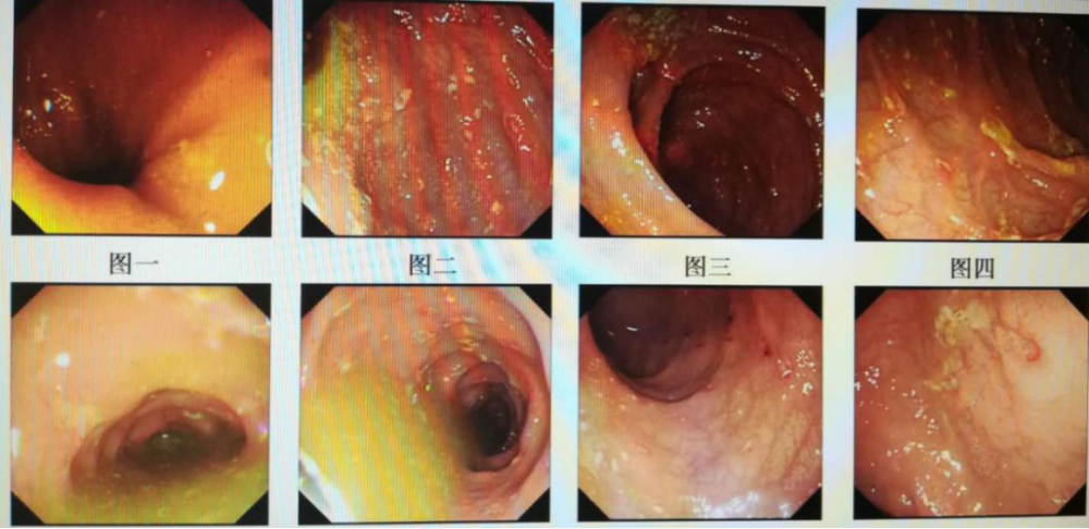 生物制剂的最佳选择:乌司奴单抗治疗克罗恩病快速实现