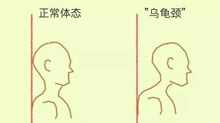 健身教练知识库:脖子前倾 "乌龟颈"的改善方法