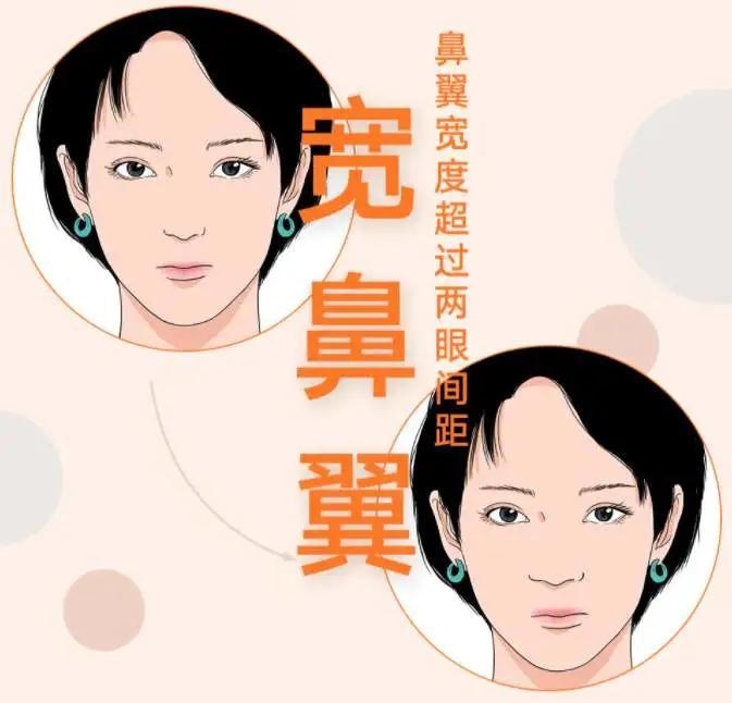 如果鼻翼宽度明显超过眼间距就属于: 宽鼻翼, 会有失美感.