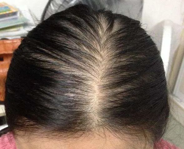 女性脱发的原因和治疗患者须知别等掉光了