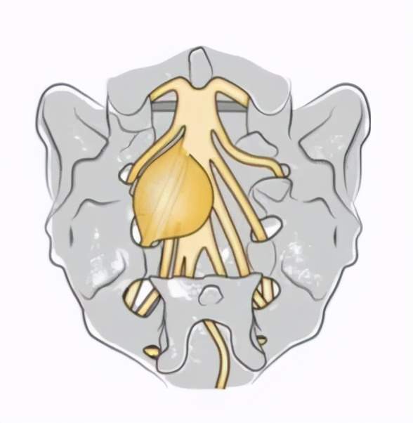 查出骶管囊肿了怎么办别慌只有两种情况才需要处理