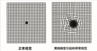 a4纸人生表格可粗略自查黄斑病变