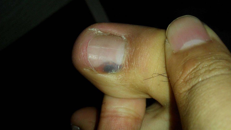 指甲下面长皮肤癌,叫做黑色素瘤
