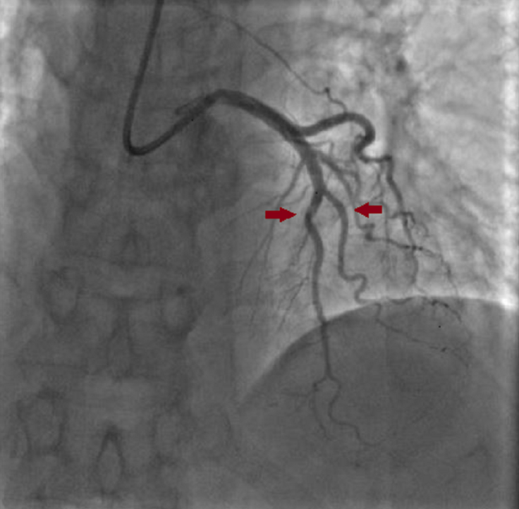 图4 冠状动脉造影显示,注射异硝酸异山梨酯后血管痉挛完全缓解.