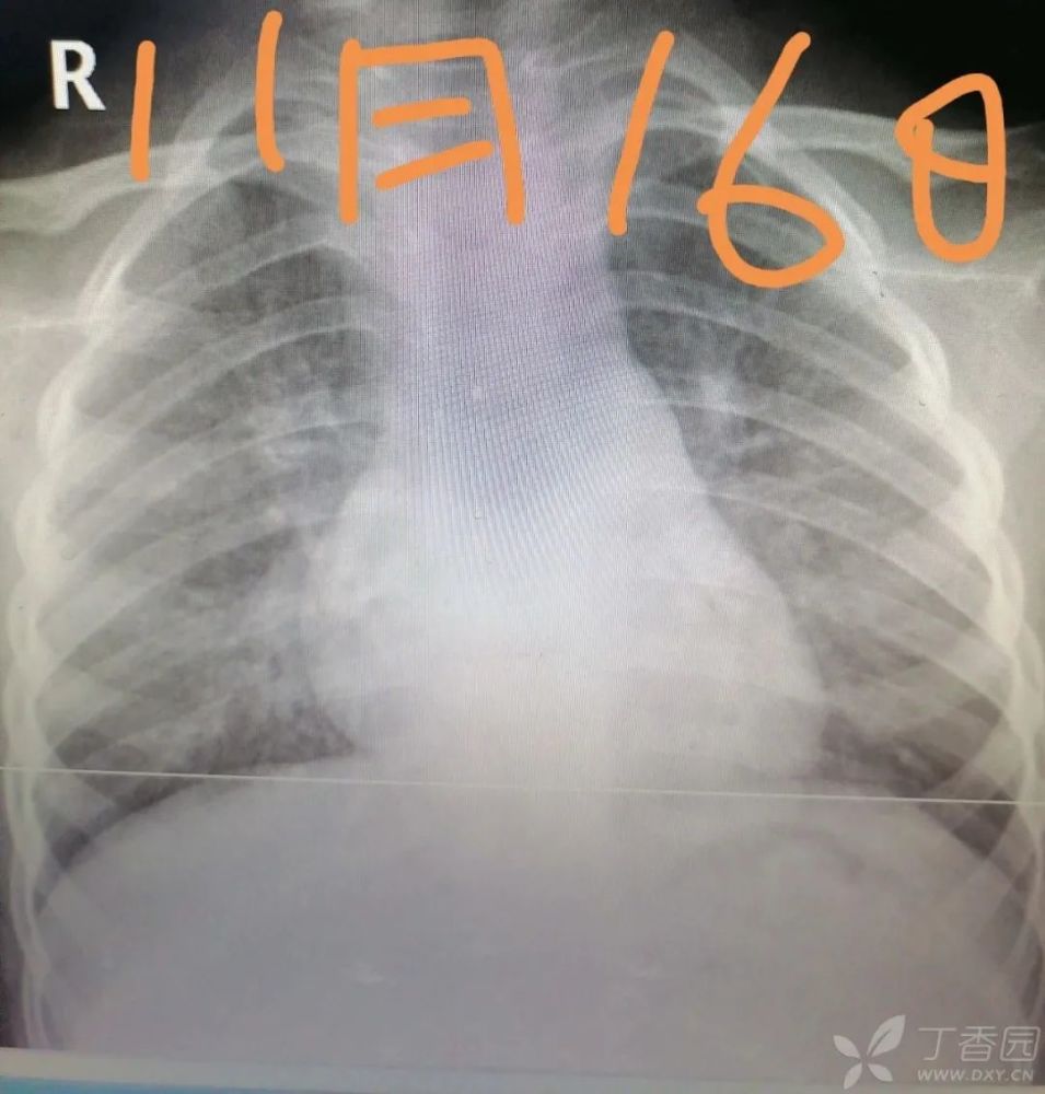 患儿肺炎反复,难治,如何诊治?