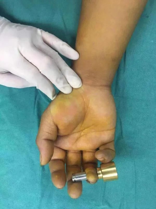病人是被冲床压伤完全穿透手指,手术恢复如初