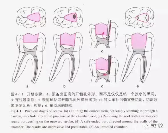 一些开髓洞型的图片