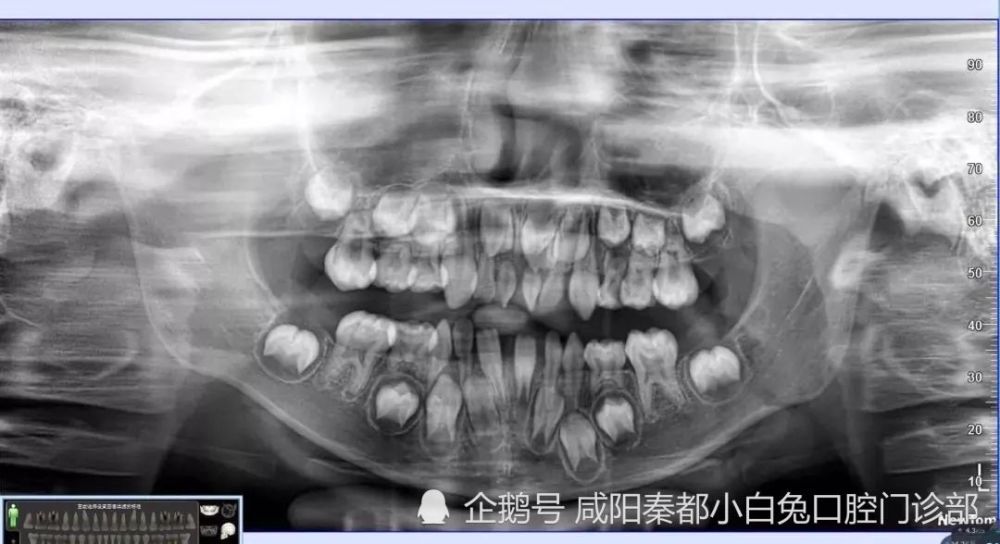 是恒牙在替牙期未萌出,但乳牙已明显超出正常换牙年龄极限而仍未脱落