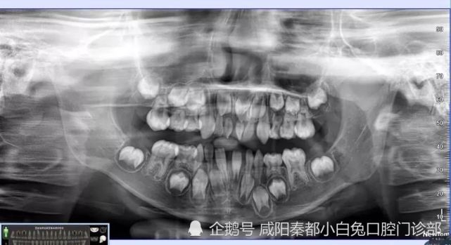 乳牙龋齿和滞留是常见的乳牙问题?