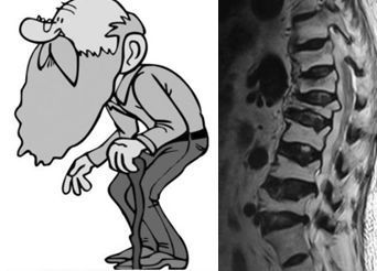 腰椎间盘突出症与强直脊柱炎都有哪些不同之处分别有什么特征