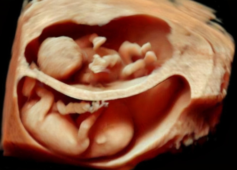 异卵双胞胎就不同了,两个胚胎的着床时间同,先"落脚"的老大会占据一个