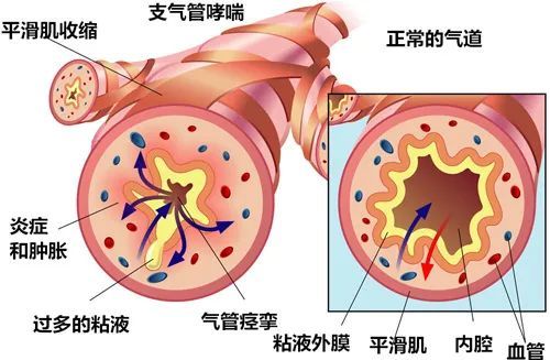 硒对不同疾病的作用|硒与哮喘|支气管哮喘|气管|呼吸道感染|哮鸣音