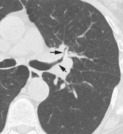支气管截断征是肺癌的 ct 征象之一.但也可见于创伤性气管及