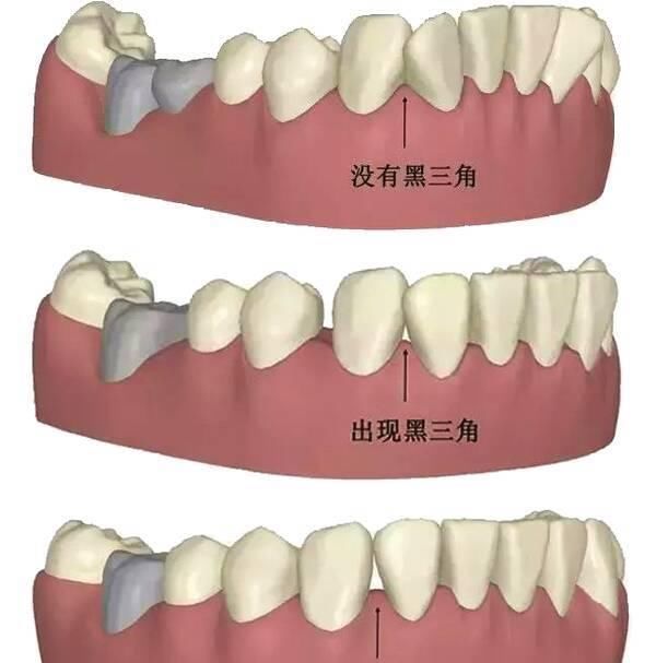 【科普】牙龈萎缩后牙间隙会出现类似三角形的区域,称