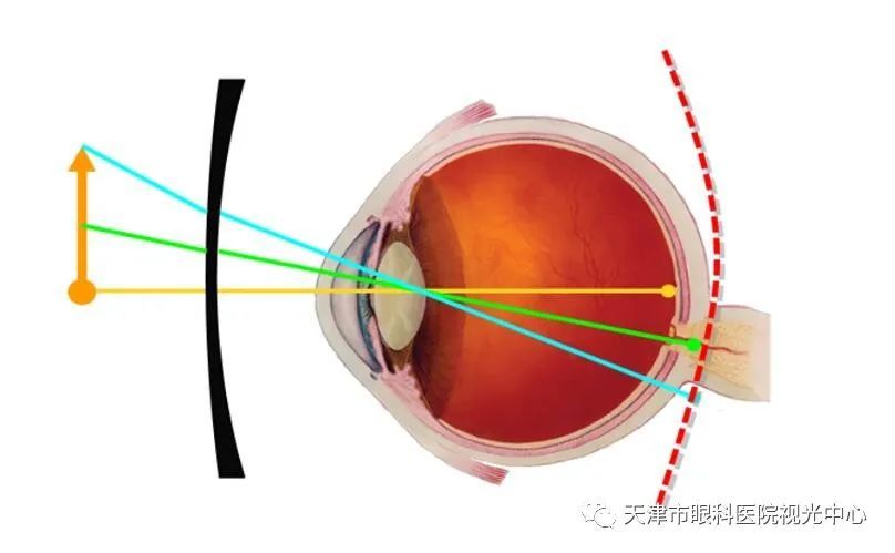 离焦镜片矫正的近视眼:离焦镜片通过特殊光学设计不仅使中心视力处