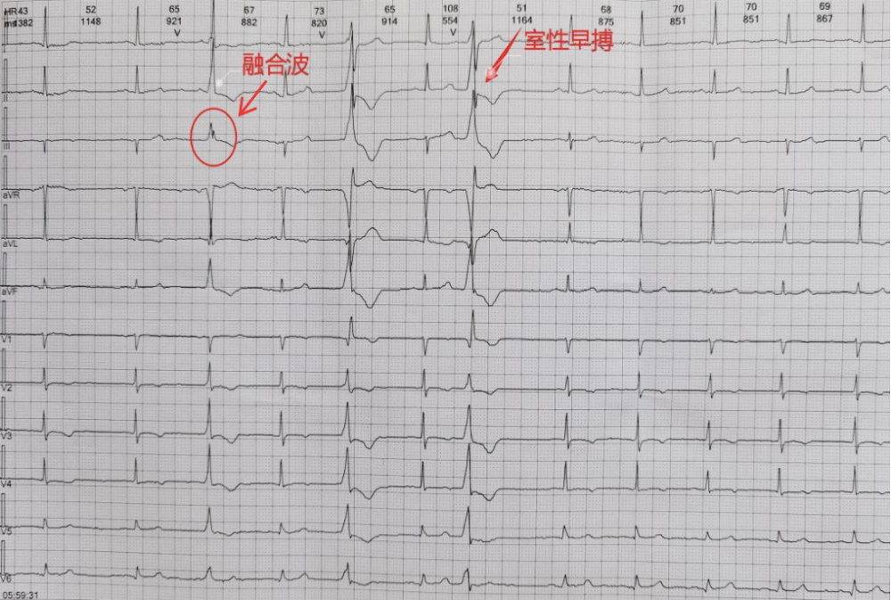 心电图不会看这10个诊断特征需牢记