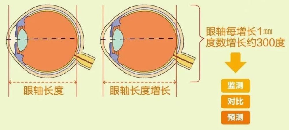 因此,高度近视的人,眼轴就会比一般人长很多,有可能表现为眼球突出
