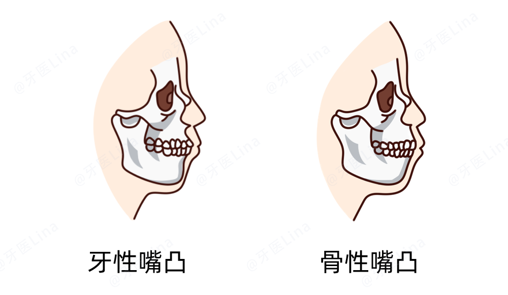 错颌畸形一般分为牙性和骨性,这里拿嘴凸举例.