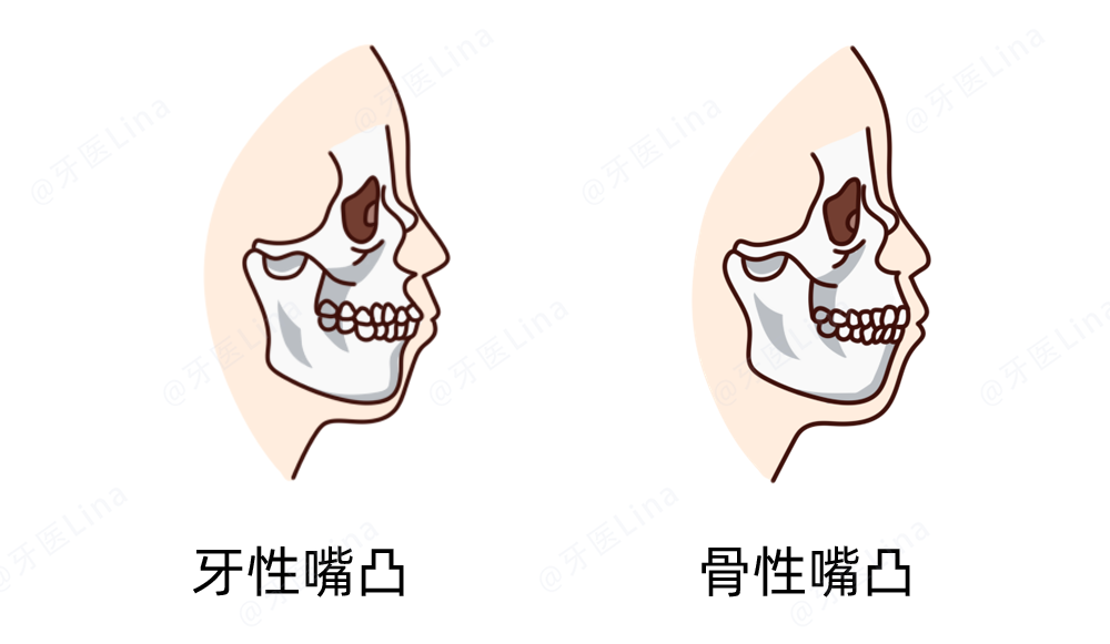 针对情况的不同 错颌畸形一般分为牙性和骨性,这里拿嘴凸举例.