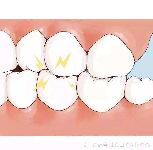 多人口腔音_口腔溃疡图片(3)