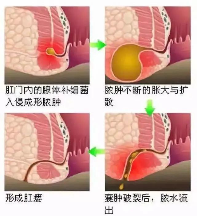 痔疮:一般肛门较少有分泌物,当内痔严重脱出时,有分泌物存在,但分泌